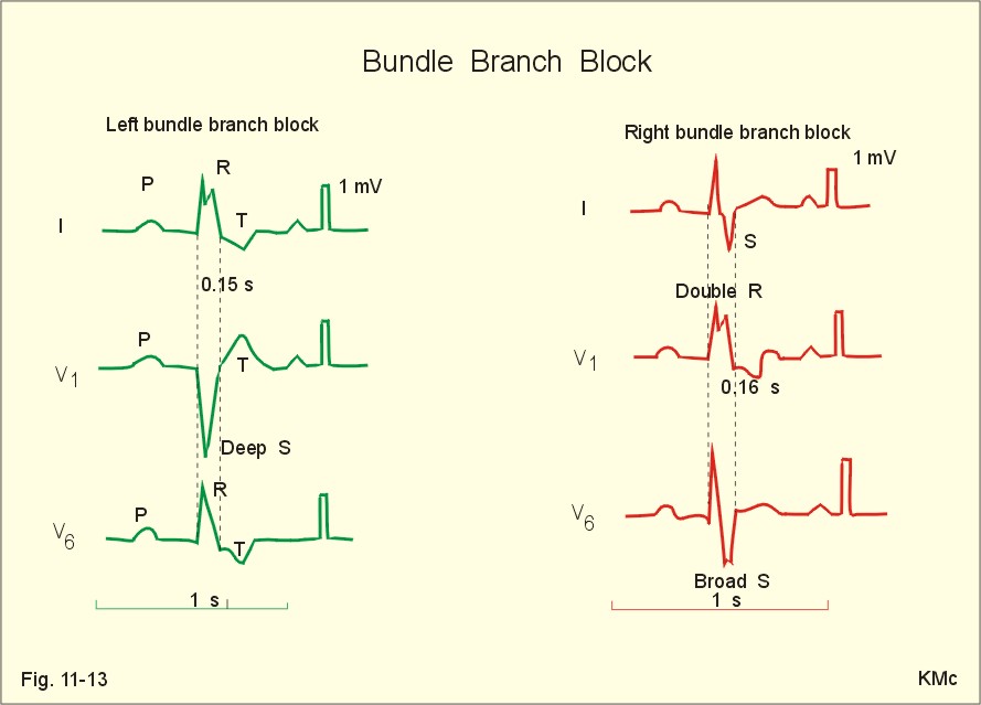 bundle branch block