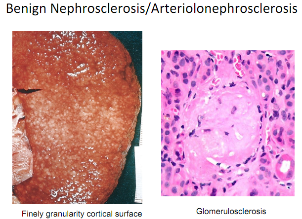 Nephrosklerose